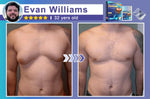 NanoMedix Chest Firming Fatburn Patch