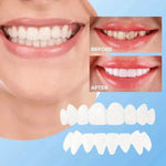 Natural Look Dental Veneers