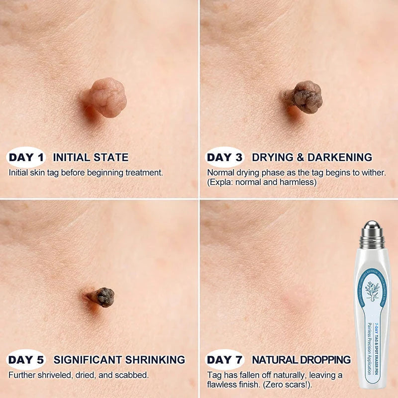 Pure Skin Spot Removal Roller