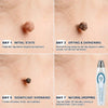 Wart Removal Rollerball Serum